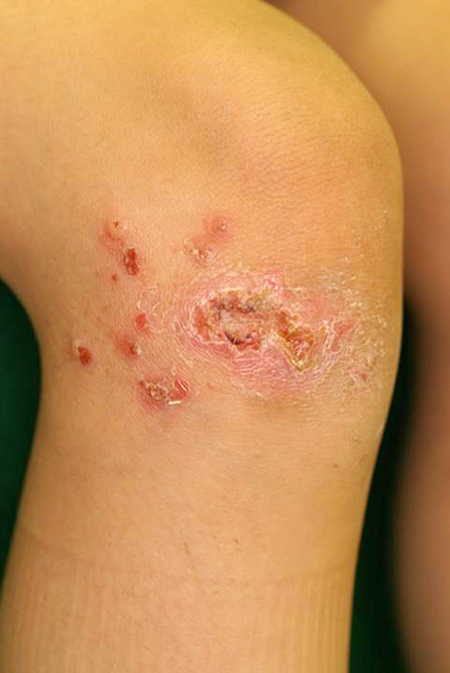 伝染性膿痂疹 とびひ 広島市南区段原日出の皮膚科 アレルギー科 しんどう皮ふ科アレルギー科